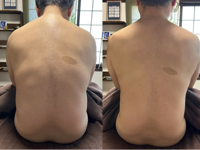 トーンヌールデトックスを背中に2箇所貼るだけで大変化!_relaxation MANA
