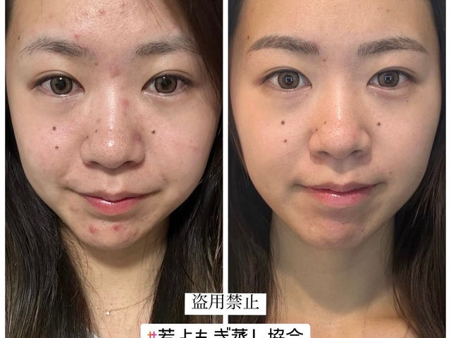 大人のニキビケアにも◎味覚も正常になり、甘いものを食べなくてもよくなったそうです!_隠れ家サロン アンシャンテ