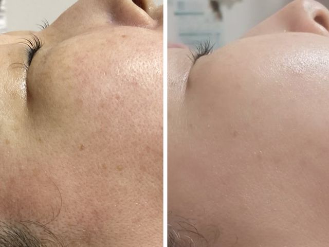 リアボーテのホームケアとお手入れ併用の変化_つど払いSalon Angel【アンヘル】