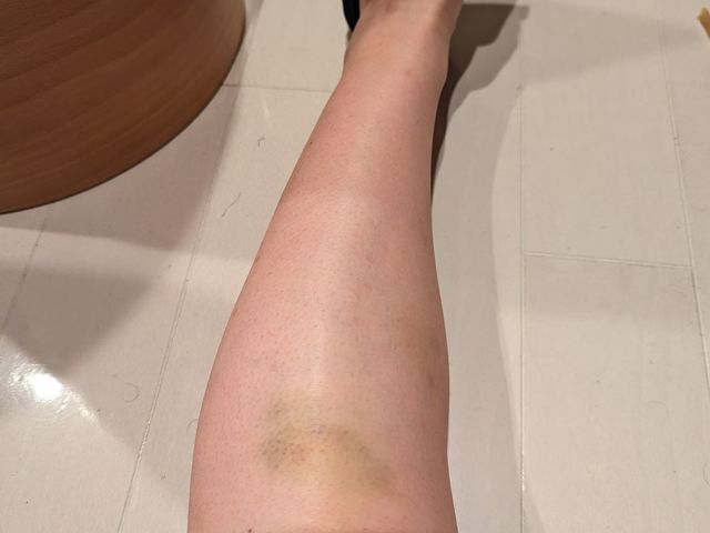 四輪バギー体験して6日目 バギー中、脛とふくらはぎの所に鉄の棒がめちゃくちゃ当たり痛かったです_ガジュマルンチャー糸満店